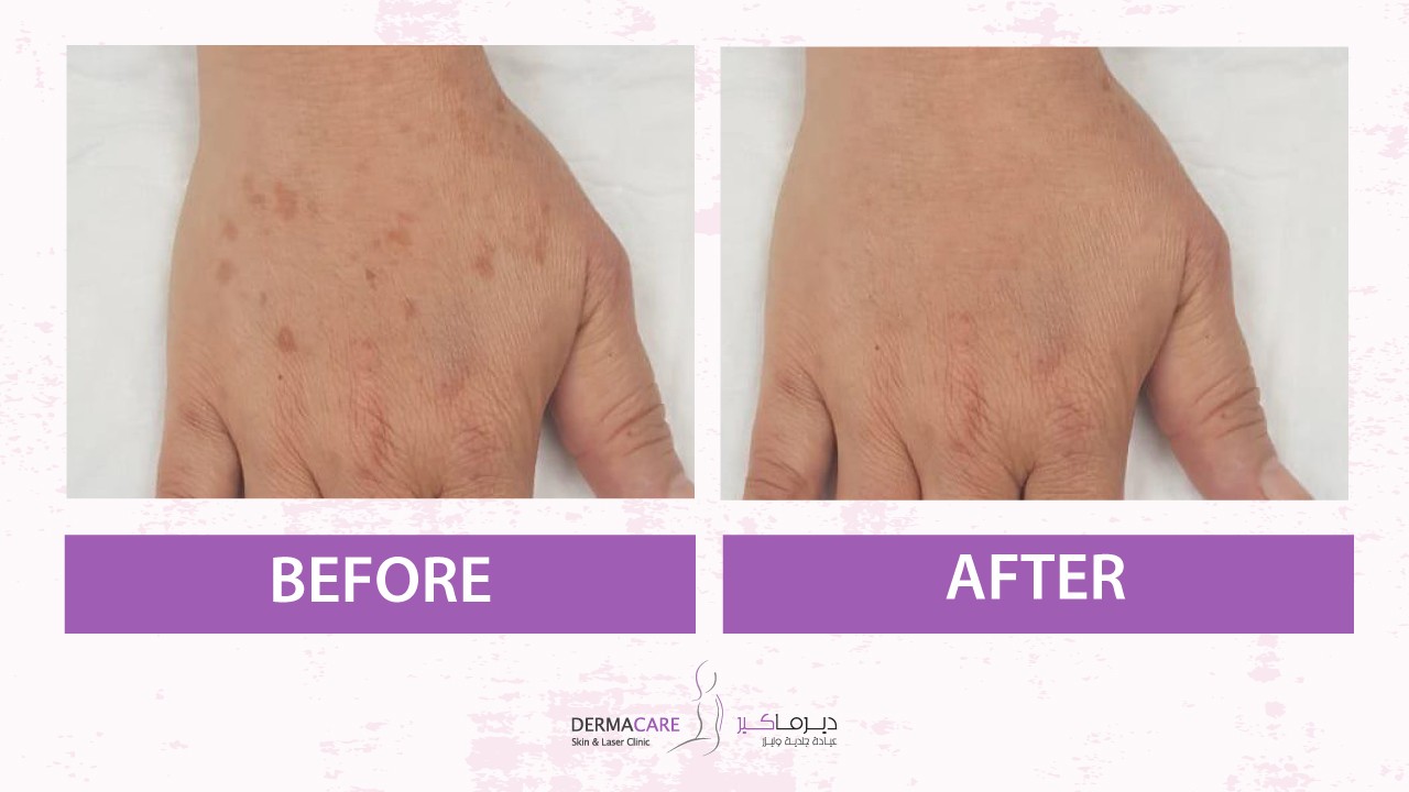 علاجات اليدين والذراعين