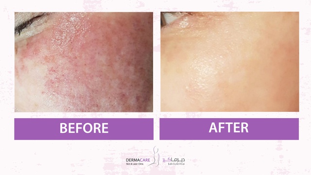 Facial redness - Image 3