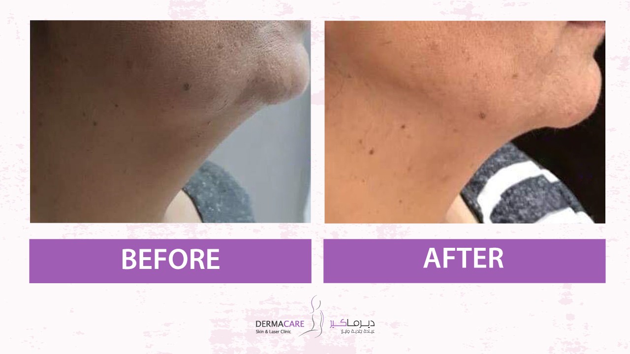 Double Chin and Neck