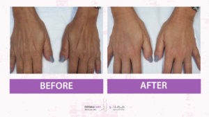 علاجات اليدين والذراعين