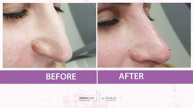 Nose reshaping - Image 3