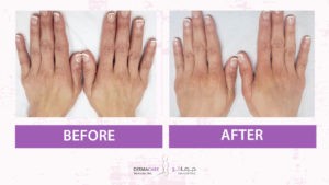 علاجات اليدين والذراعين