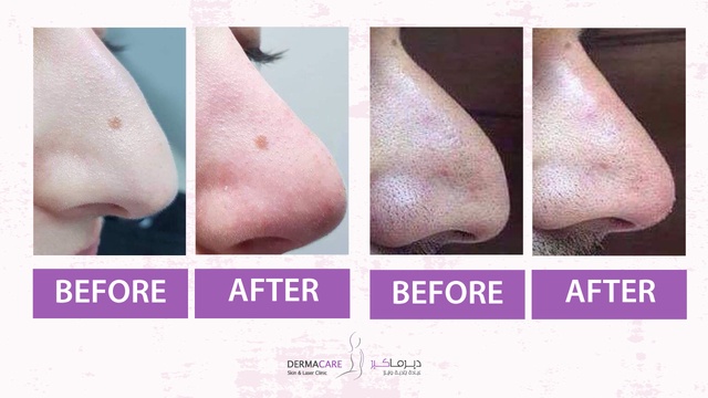 Nose reshaping - Image 2