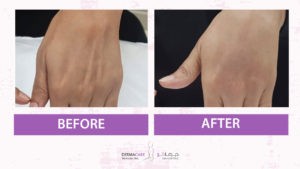 علاجات اليدين والذراعين