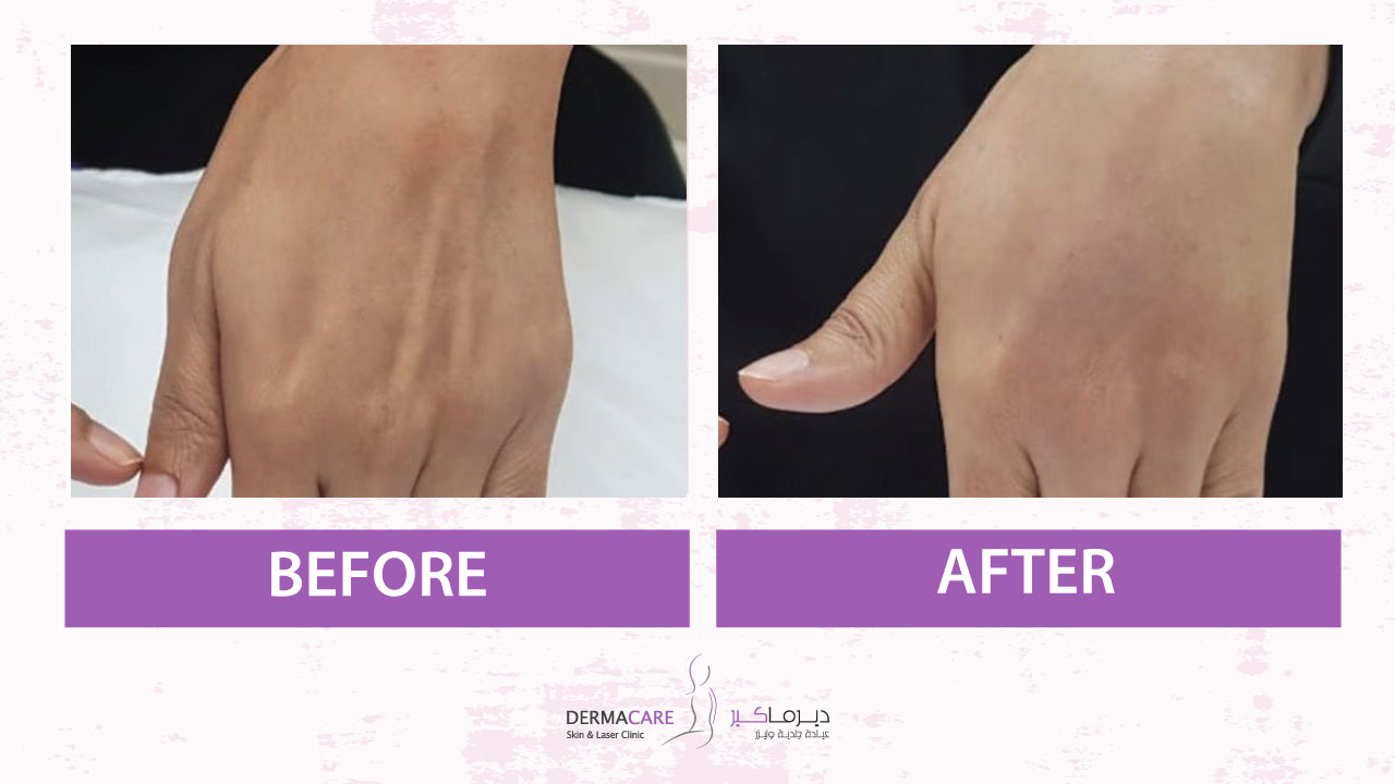 علاجات اليدين والذراعين