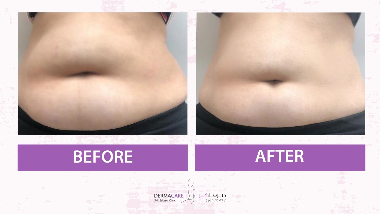 Body sculpting & reshaping - Image 2