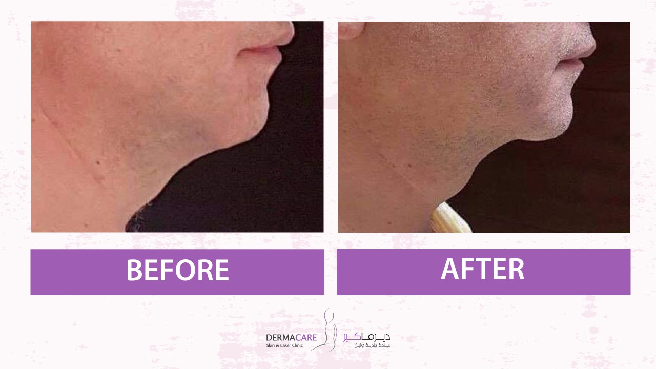 Focused Ultrasound Technology - HIFU - Image 4