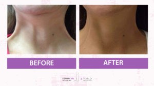 Double Chin and Neck