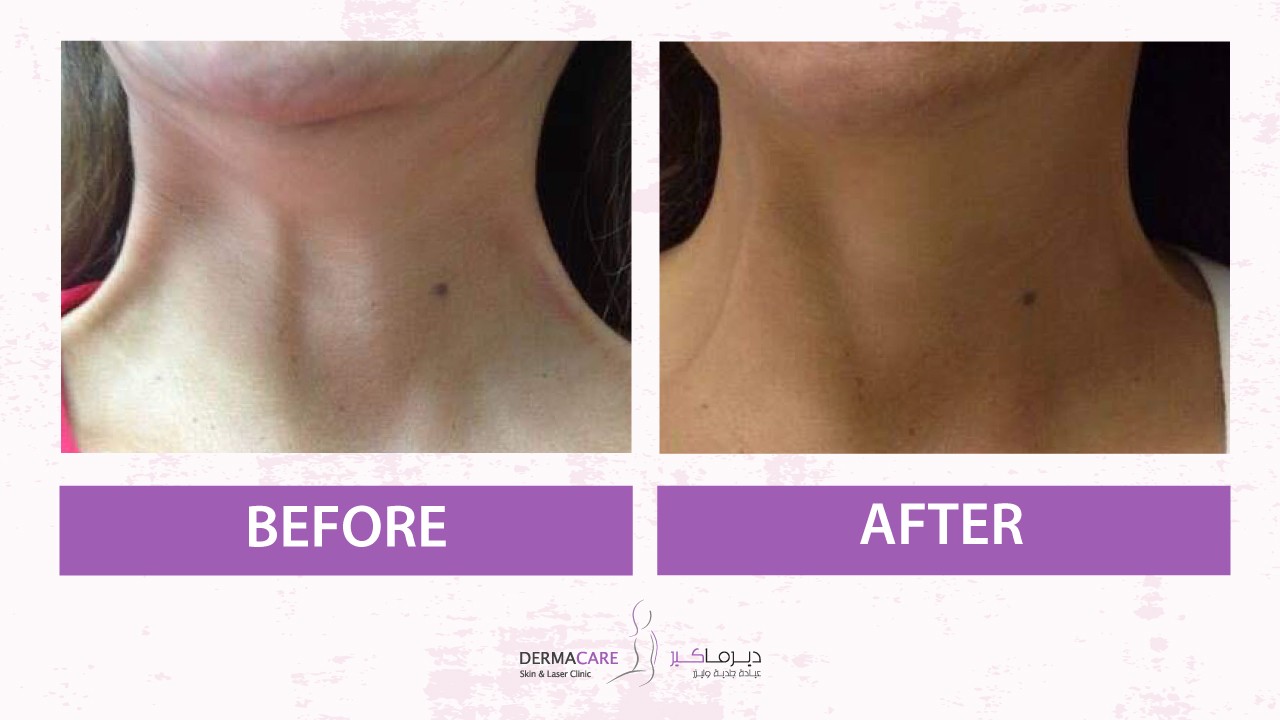 Double Chin and Neck