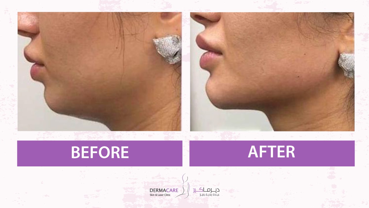 Focused Ultrasound Technology - HIFU - Image 3