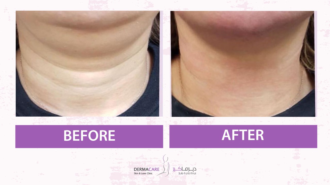 Double Chin and Neck