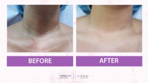 Double Chin and Neck