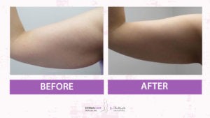 علاجات اليدين والذراعين