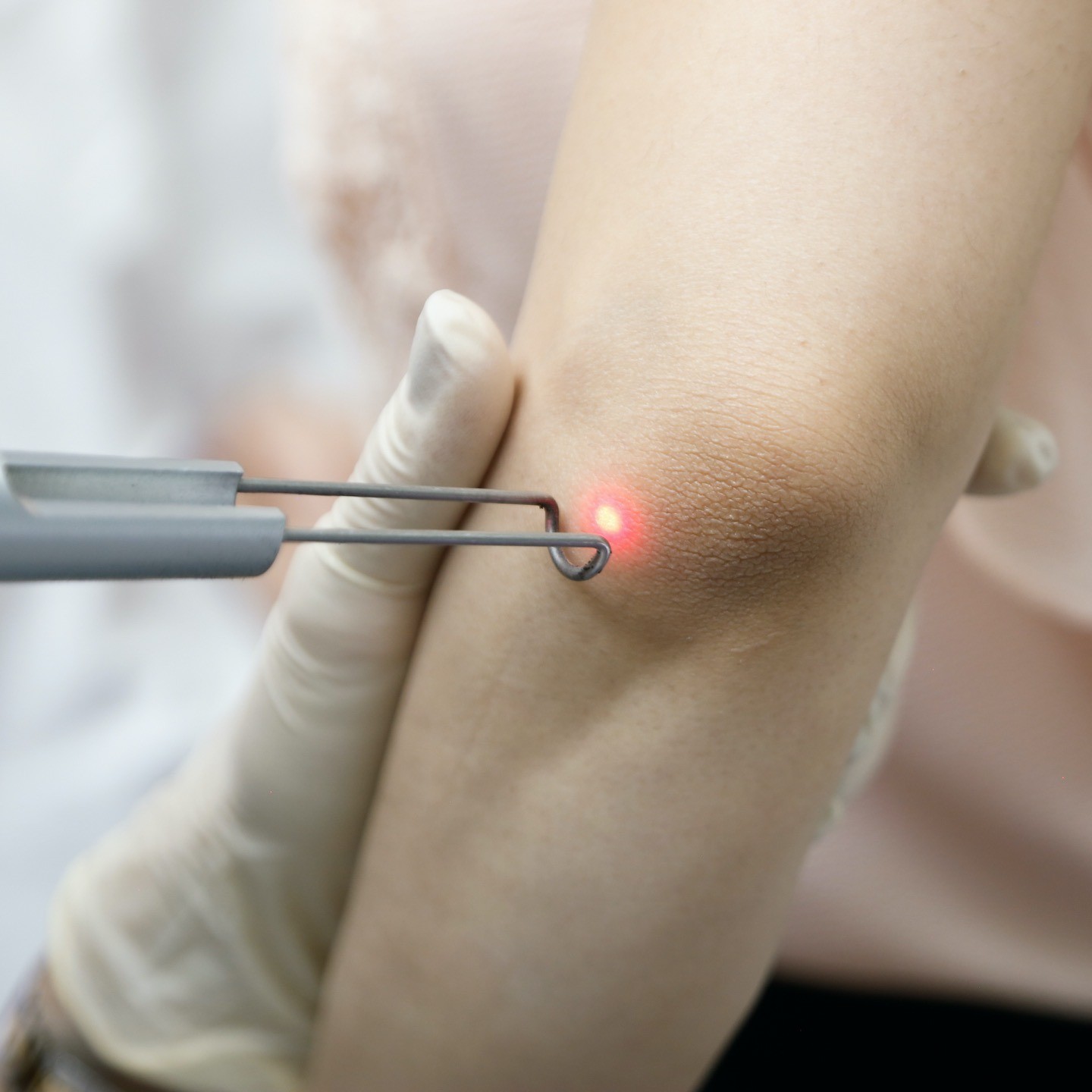 Q-switched laser - Image 3