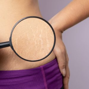 Stretchmark treatment
