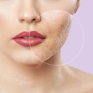 Acne scars treatment