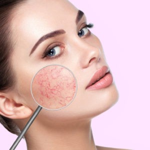 Rosacea