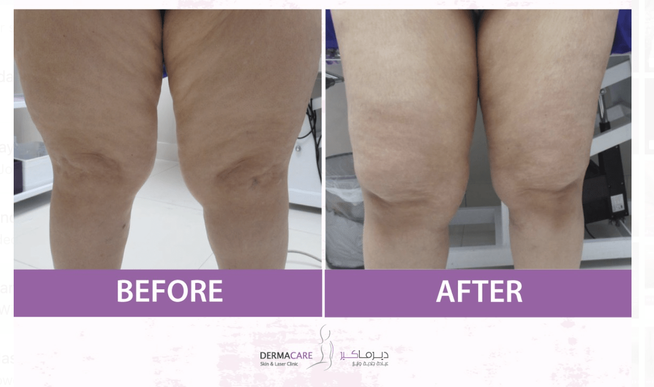 Body sculpting & reshaping - Image 3