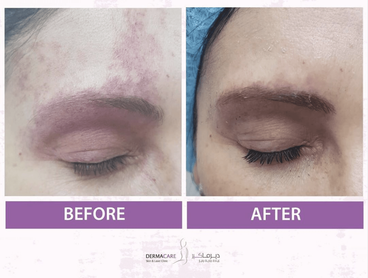 Pulsed Dye Laser (PDL) - Image 3