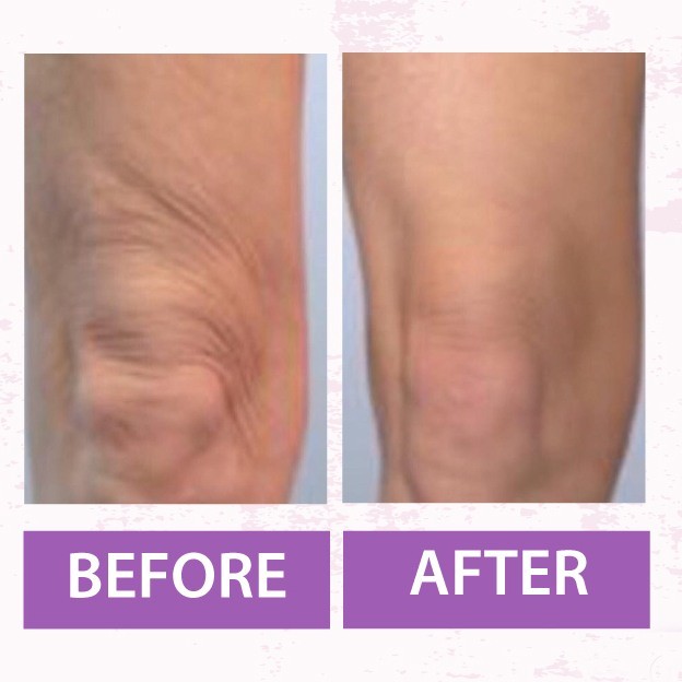 Thighs and knees tightening - Image 2