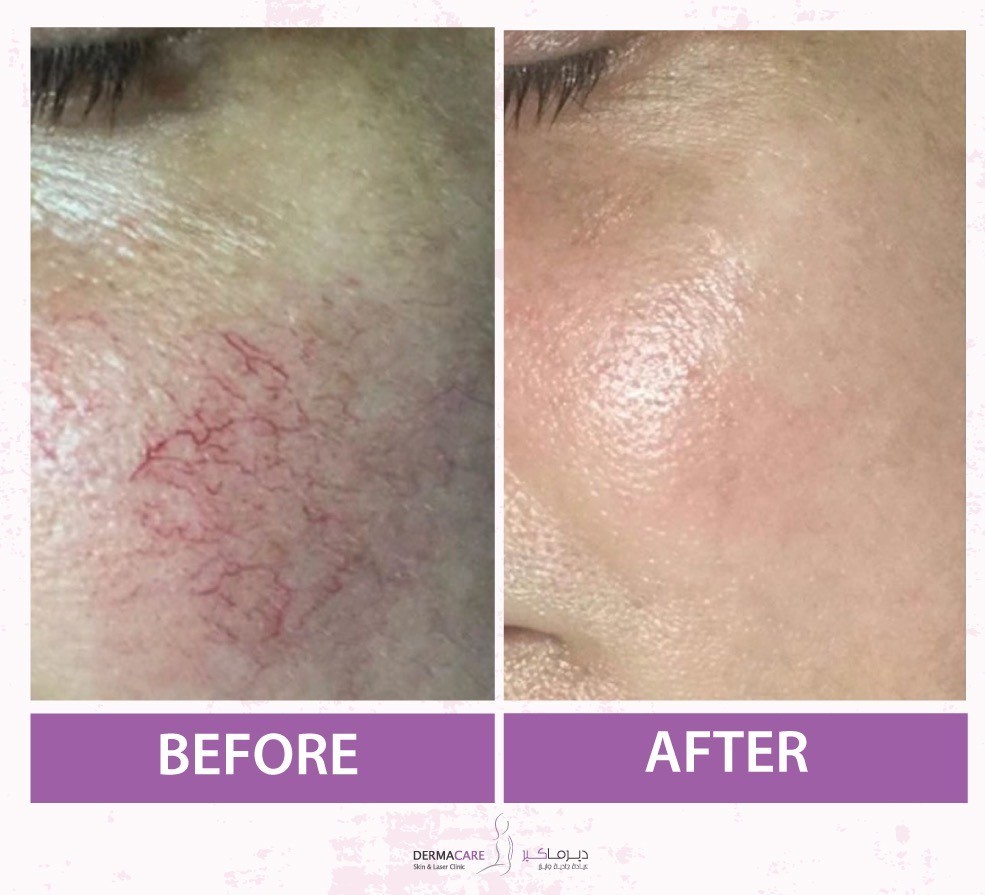 Pulsed Dye Laser (PDL) - Image 4