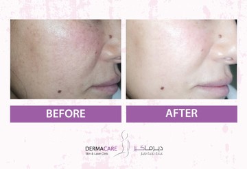 Facial redness - Image 2