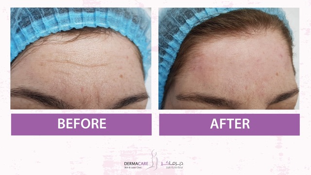 Botox for wrinkles - Image 3