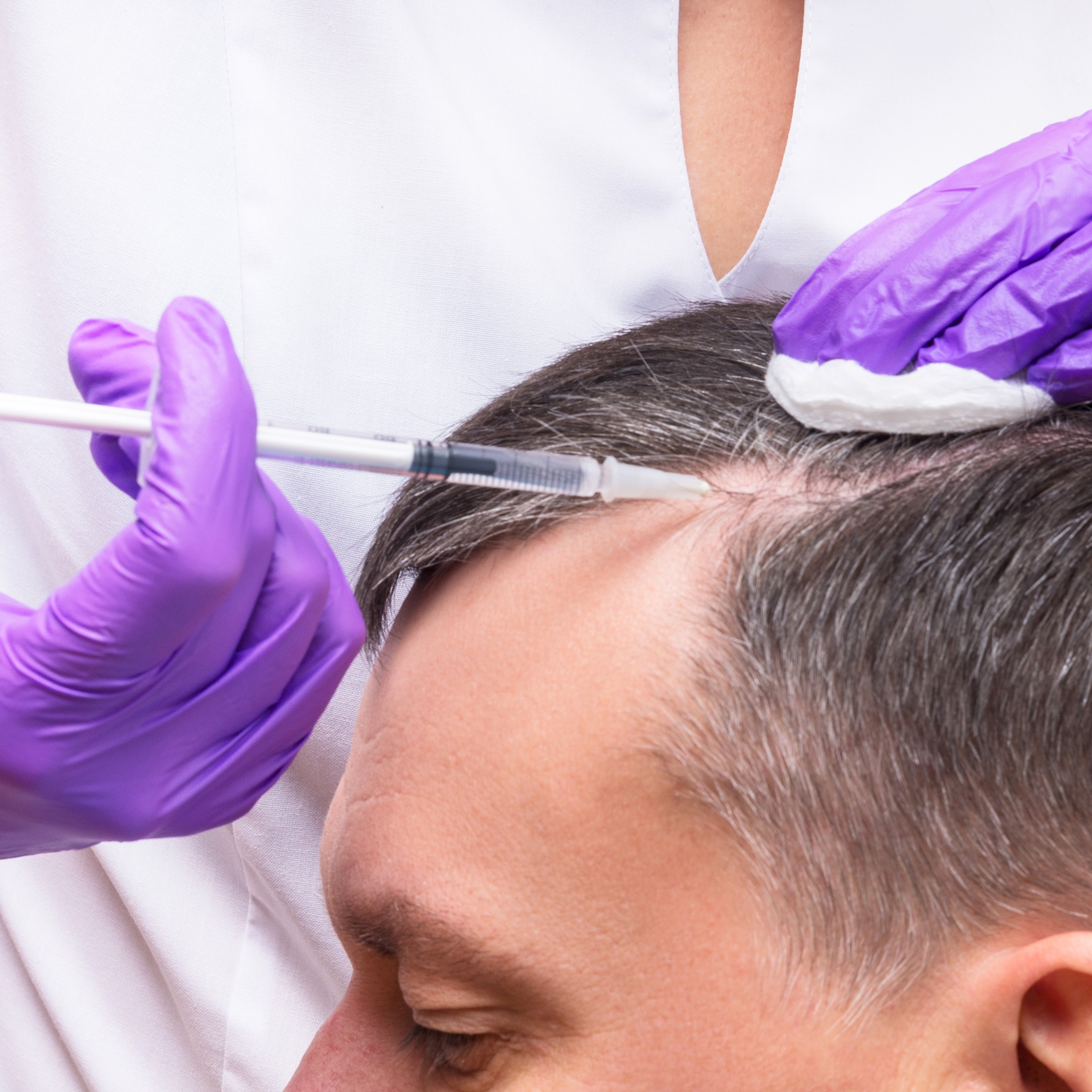 Mesotherapy for treating hair fall & the scalp