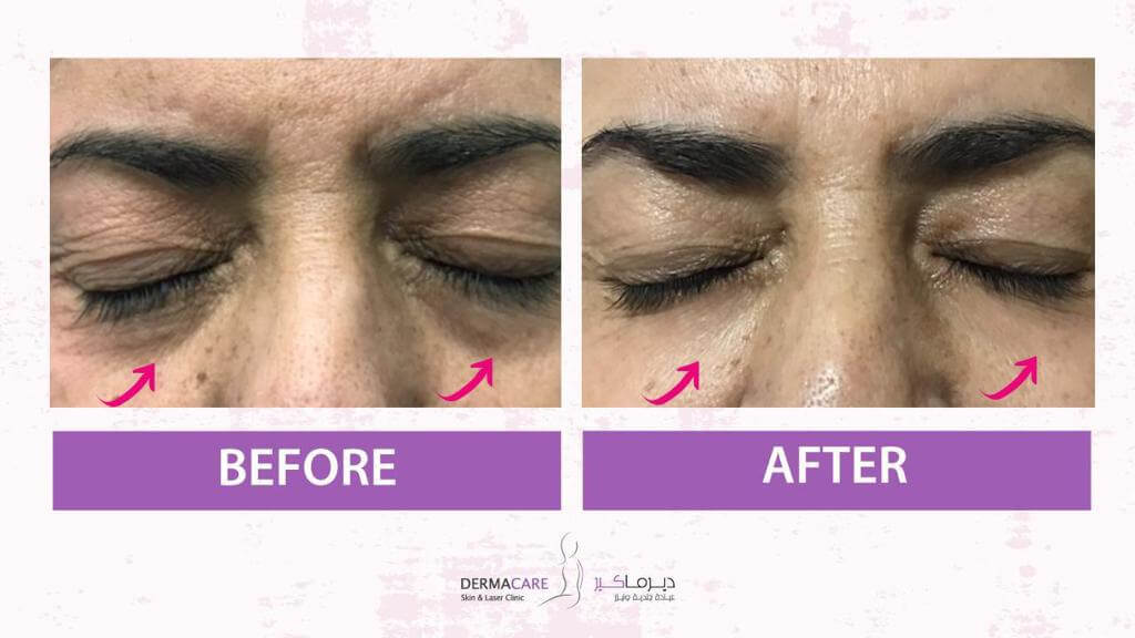 Non-surgical Face Lift