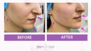Non-surgical Face Lift