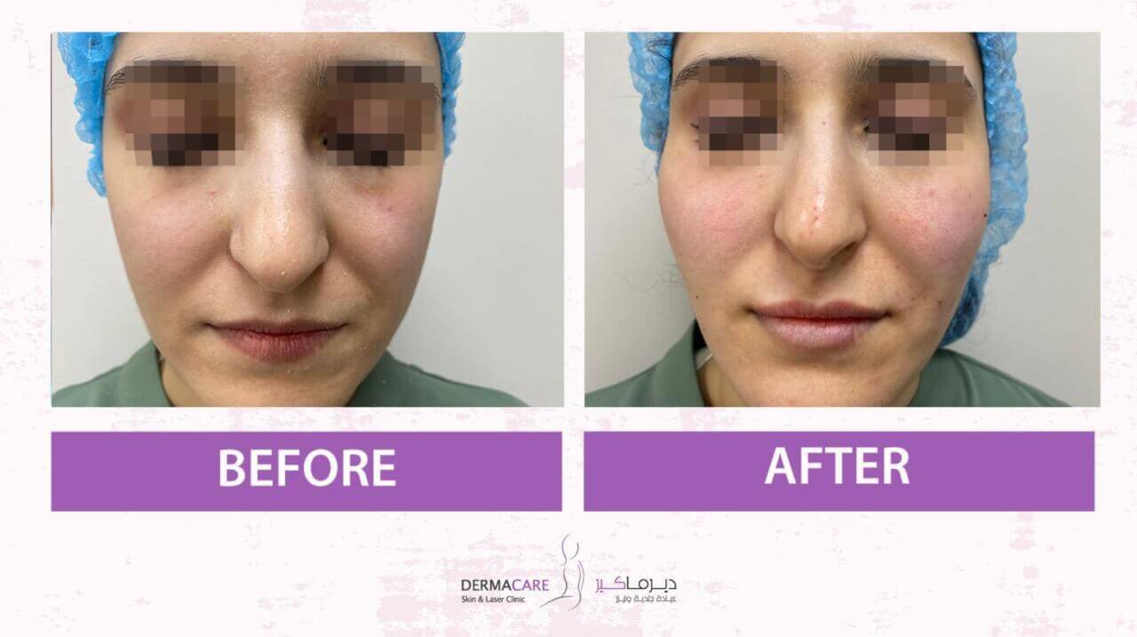 Non-surgical Face Lift