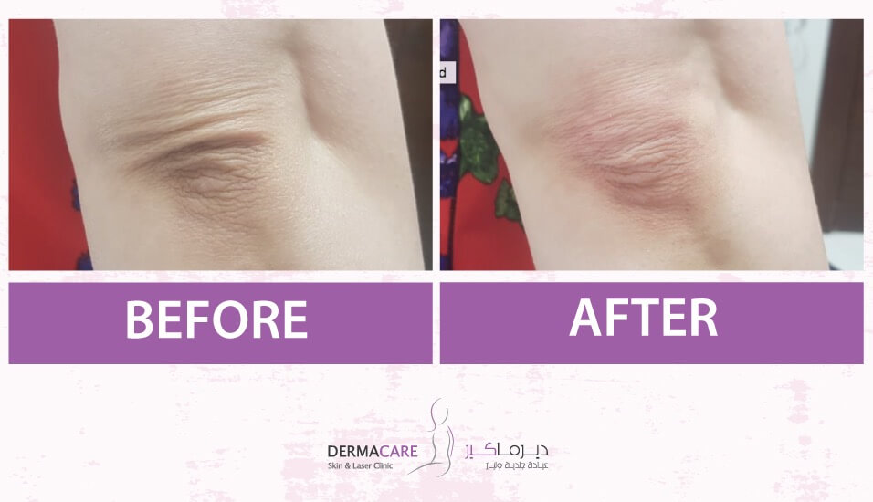 علاجات اليدين والذراعين