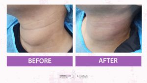 Double Chin and Neck